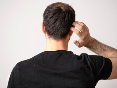Consejos para combatir los picores en el cuero cabelludo